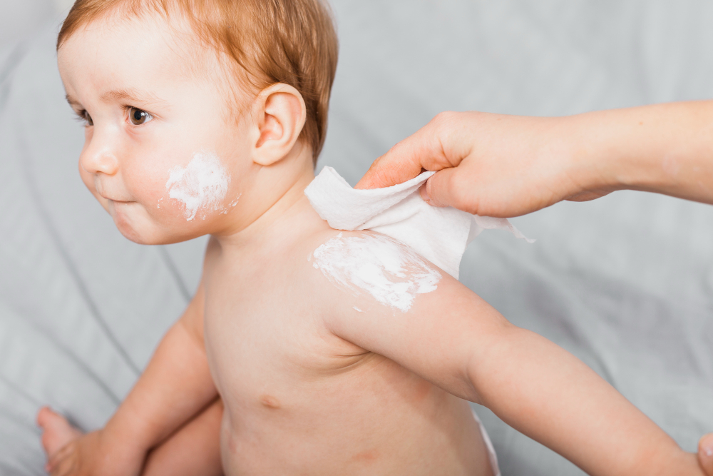 dermatite atopica  bambini