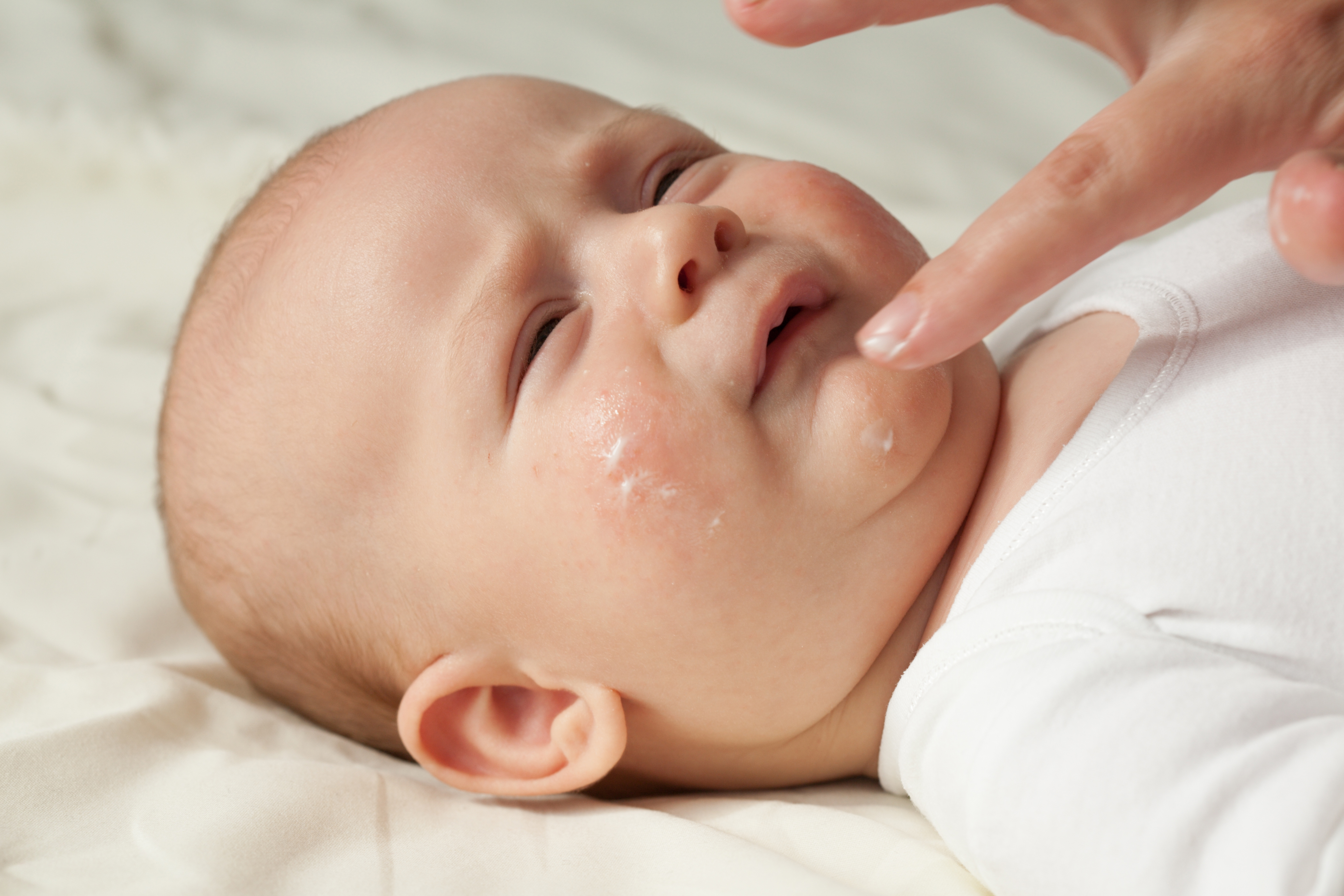 dermatite atopica  bambini