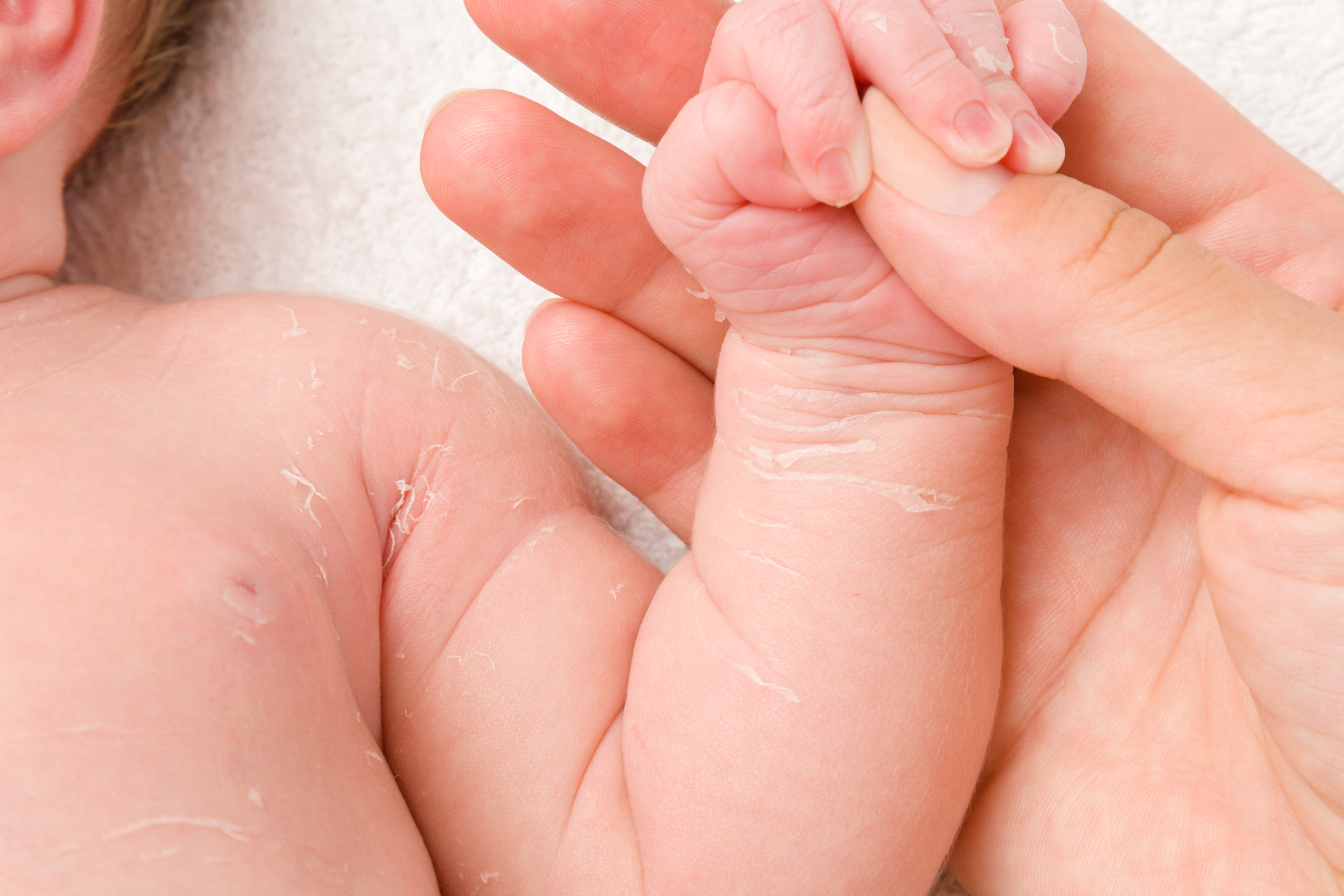 mamma spalma crema su pelle screpolata neonato