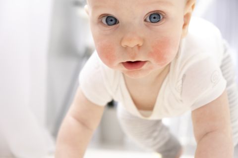 bambino con dermatite atopica in spiaggia